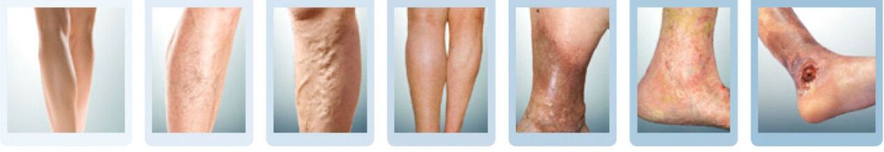 stades de développement des varices des jambes
