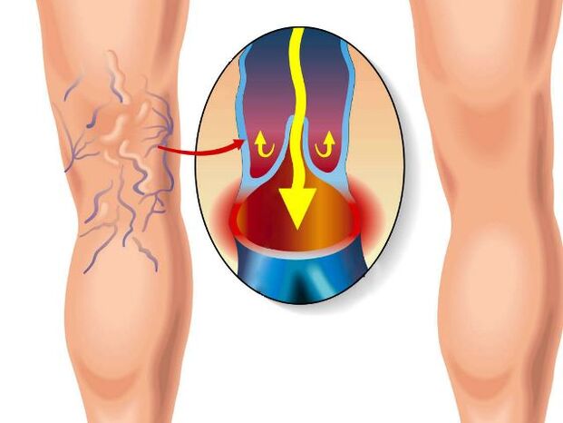 jambe saine et varices dans la jambe