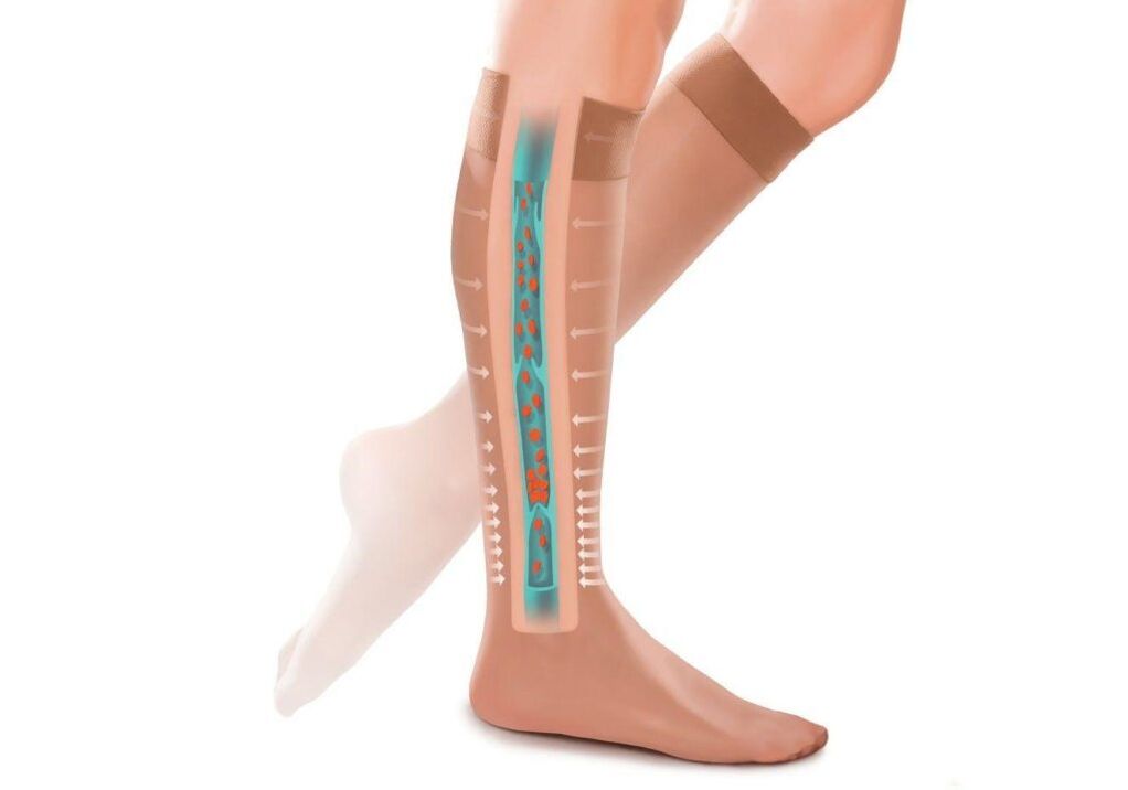 l'effet des bas de compression sur les jambes avec des varices
