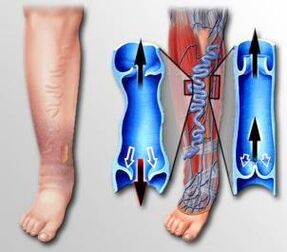 flux sanguin dans la jambe avec des varices