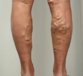 ganglions lymphatiques dans les jambes avec des varices