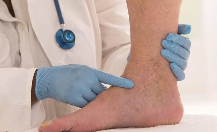 le médecin examine la jambe avec des varices