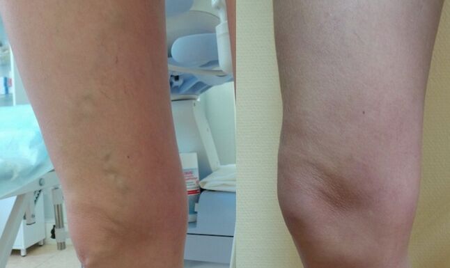 jambe avant et après traitement des varices réticulaires