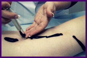 La procédure pour traiter les varices avec des sangsues (hirudothérapie)