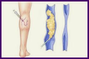 La sclérothérapie est une méthode populaire pour se débarrasser des varices sur les jambes. 