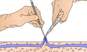 chirurgie des varices