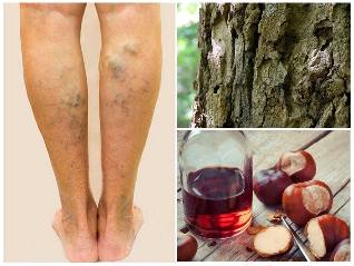 le Traitement des Varices de la jambe médecine traditionnelle