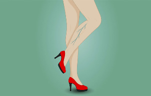 Varices sur les jambes d'une femme. 