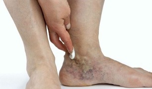 Manifestations de varices dans les jambes. 