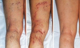symptômes de varices dans les jambes