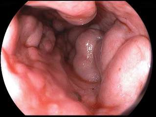 des varices oesophagiennes
