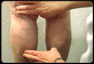 Le médecin examine les jambes avec des varices