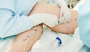 méthodes pour traiter les varices dans les jambes chez les femmes